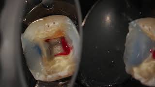 Complete endodontic treatment of a lower first molar step by step [upl. by Usanis]