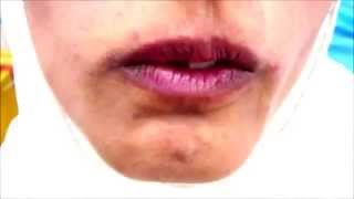 Orofacial Dyskinesia [upl. by Leimad]