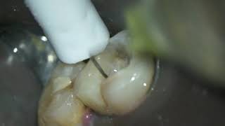 Caso clínico Dr Hipólito Fabra con limas de endodoncia Proclinic Expert [upl. by Aissilem]