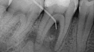 Endodoncia en Molar Inferior [upl. by Welcher]